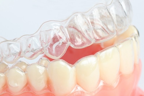 Tips for Cleaning Your Invisalign Aligners